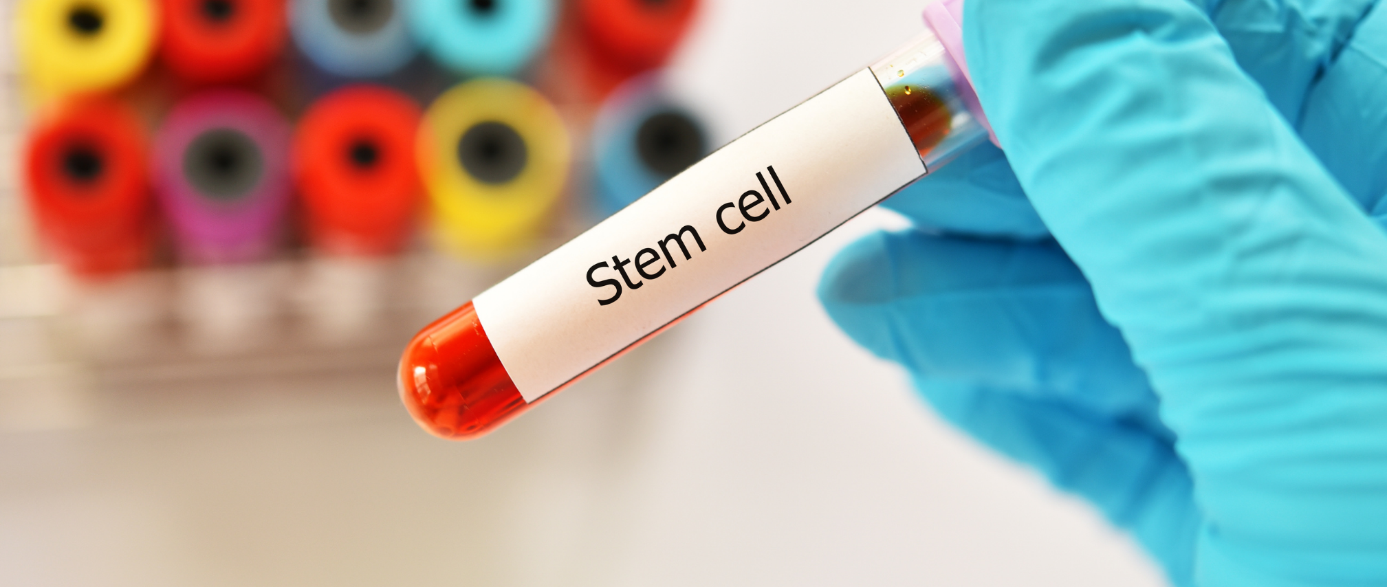 #InTheNews: U.S. patient becomes 1st woman cured of HIV after stem cell transplant